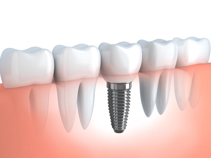 Dental Implants  Washington Terrace, UT 